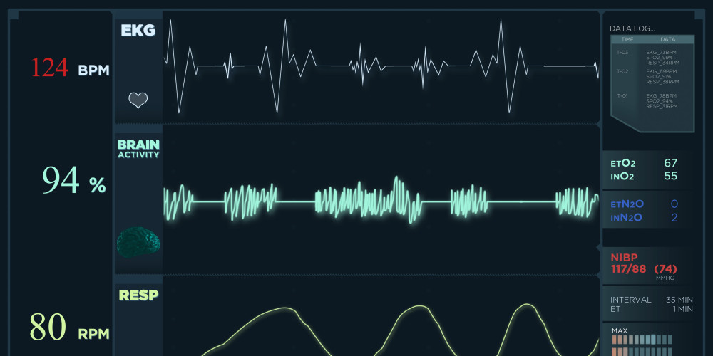 ECG